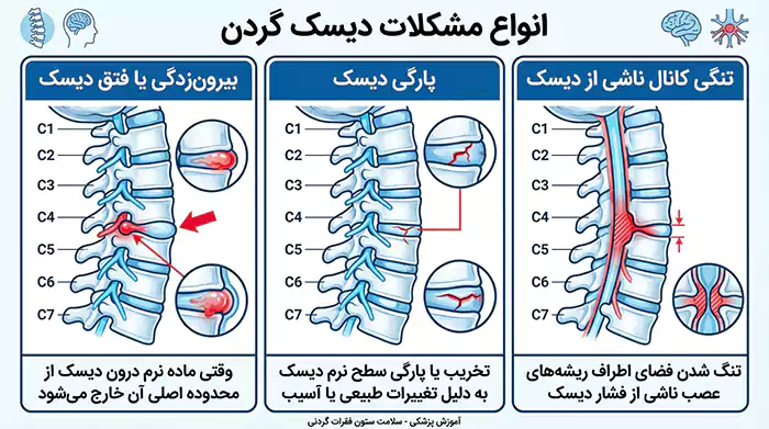 اینفوگرافیک انواع دیسک گردن
