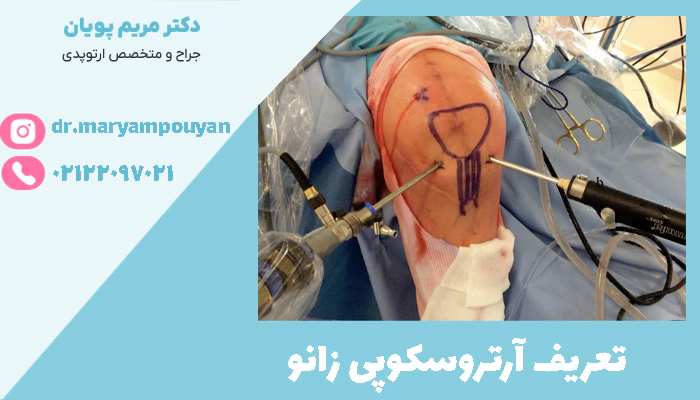 تعریف آرتروسکوپی زانو