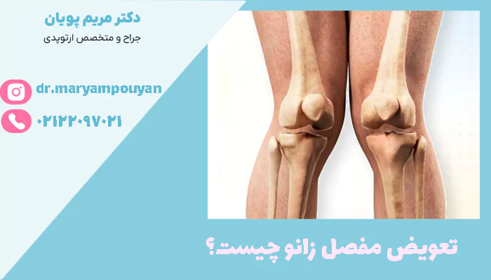 تعویض مفصل زانو چیست؟